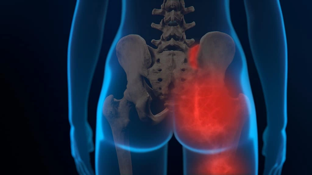 Effective Treatment For Sacroiliac Joint Pain Image