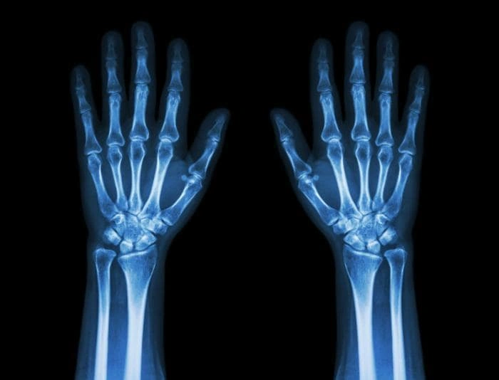 X-Ray Hands And Wrist Image