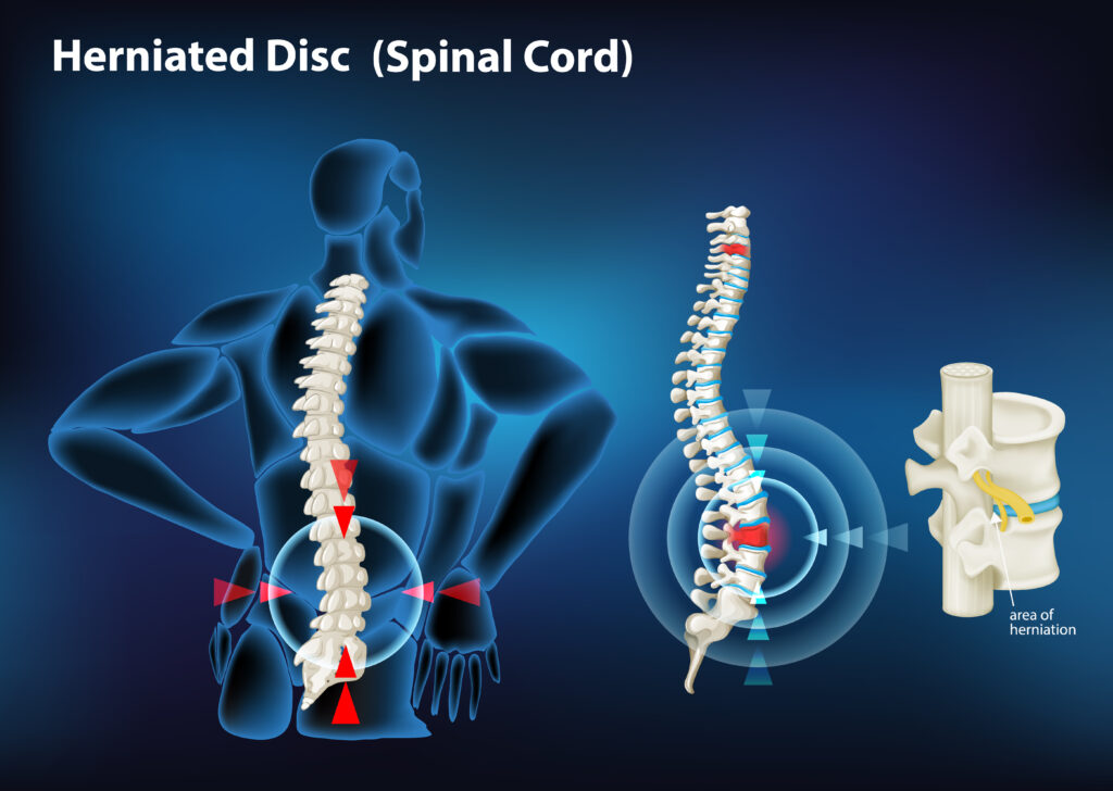 Chiropractic disc repair