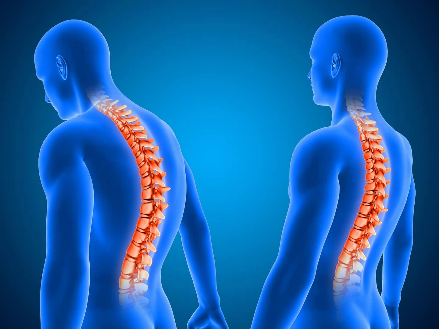 Spinal Stenosis Image
